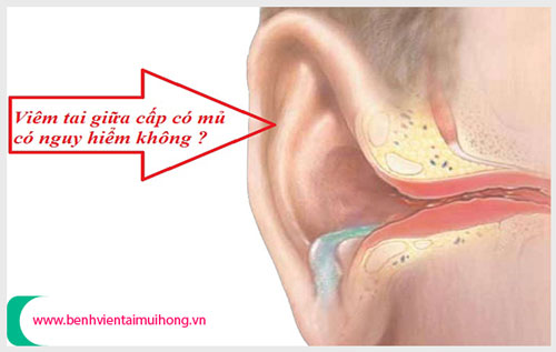 Viêm tai giữa cấp có mủ có nguy hiểm không ?