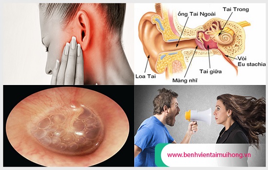 Có nhiều nguyên nhân gây điếc đột ngột 1 bên tai