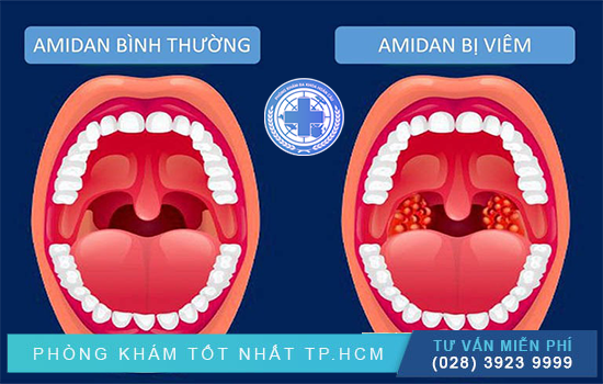 Triệu chứng điển hình và cách điều trị hiệu quả viêm amidan lưỡi