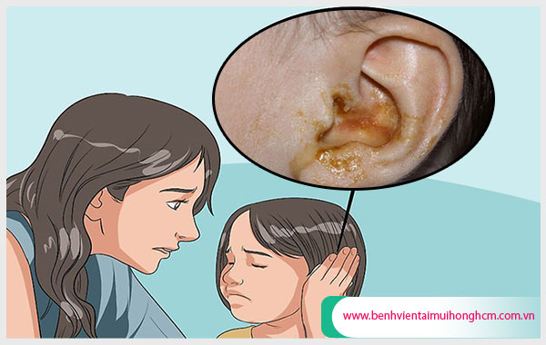 Cần phát hiện và xử lý bệnh viêm tai giữa chảy mủ cho trẻ kịp thời