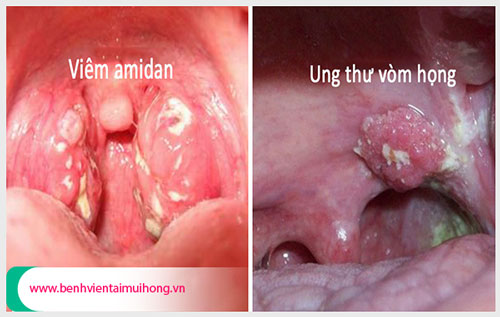 Bệnh viêm amidan có dẫn đến ung thư vòm họng hay không?
