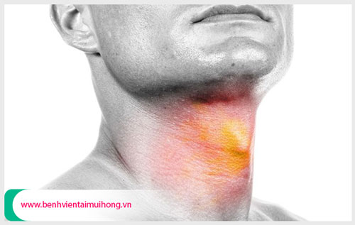 Bệnh viêm amidan có dẫn đến ung thư vòm họng hay không?