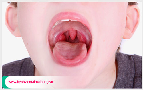 Bệnh viêm họng hạt là gì và có nguy hiểm không?