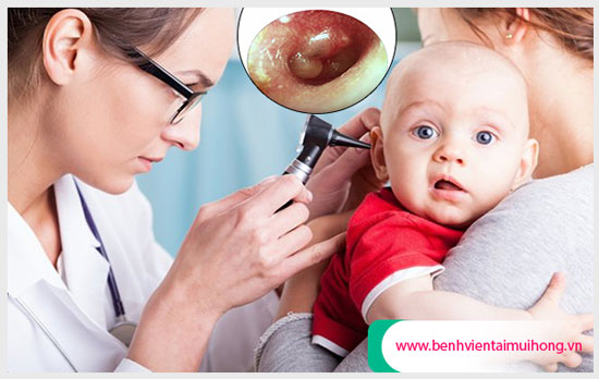 Biểu hiện viêm tai giữa ở trẻ sơ sinh cha mẹ cần hết sức lưu ý