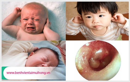 Biến chứng viêm tai giữa ở trẻ nhỏ