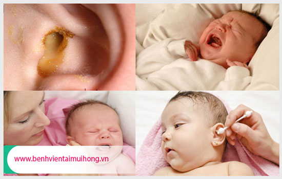 Triệu chứng viêm tai giữa ở trẻ sơ sinh