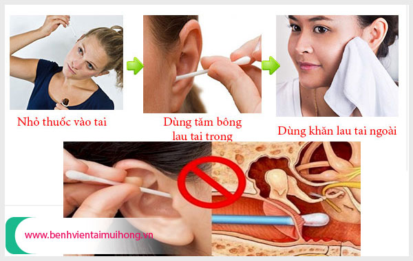 Hướng dẫn cách vệ sinh tai khi bị viêm tai giữa