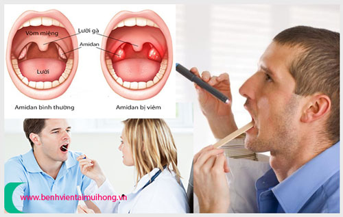 Cắt amidan ở bệnh viện tai mũi họng tp hcm 