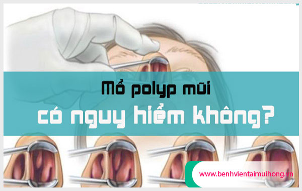 Cắt Polyp mũi không đau không biến chứng nhiễm trùng