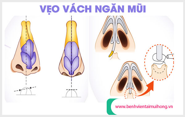 Vẹo vách ngăn mũi nặng có thể thực hiện phẫu thuật để hô hấp dễ dàng