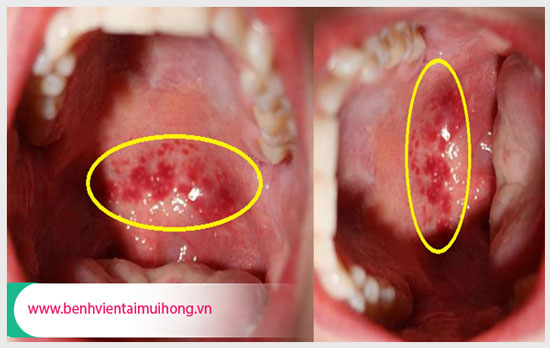 Biểu hiện của bệnh viêm họng hạt