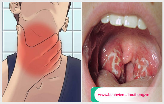 Nguyên nhân gây đau cổ họng