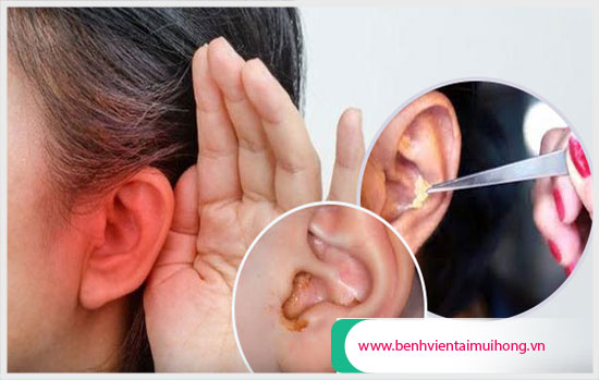 Dấu hiệu nhận biết viêm tai ngoài là gì Dau-hieu-nhan-biet-viem-tai-ngoai-la-gi-va-cach-dieu-tri-benh5