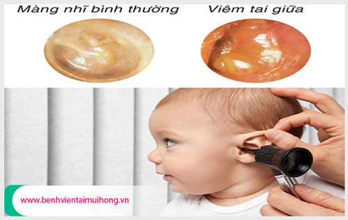 Dấu hiệu viêm tai giữa ở trẻ sơ sinh 