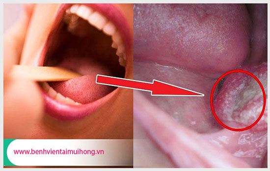 Triệu chứng đau cổ họng và nhức đầu là bệnh gì?