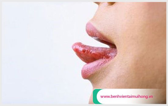 Đầu lưỡi nổi hột đỏ là bị gì? Cách chữa trị