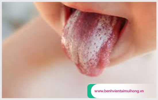 Đầu lưỡi nổi hột đỏ là bị gì? Cách chữa trị