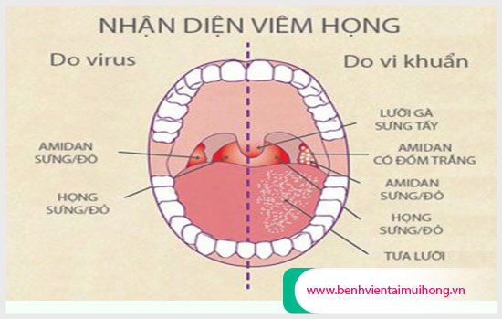 Phân biệt triệu chứng viêm họng do vi khuẩn và virus