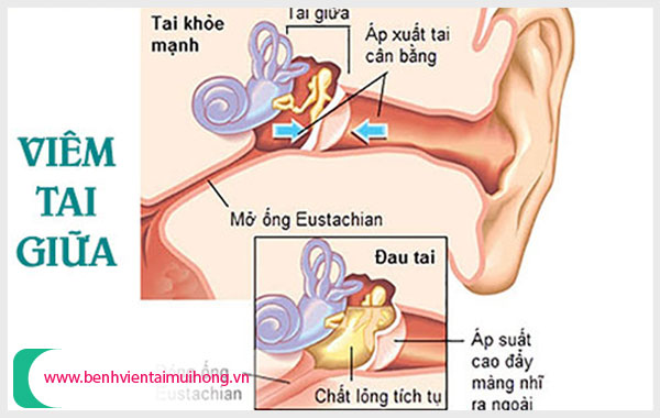 Nhận biết chính xác hiện tượng viêm tai giữa