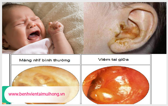 Hình ảnh viêm tai giữa ở trẻ sơ sinh