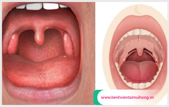 Hình ảnh vòm họng bình thường và vòm họng do mắc bệnh