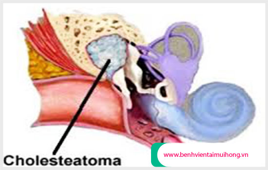 Khối u Cholesteatoma ở tai giữa là gì?