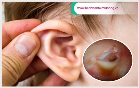 Không khó để phát hiện viêm tai giữa có mủ ở trẻ sơ sinh
