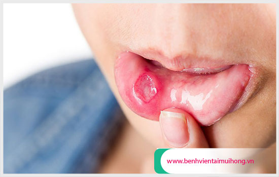 Loét miệng: Nguyên nhân, triệu chứng và cách chữa trị