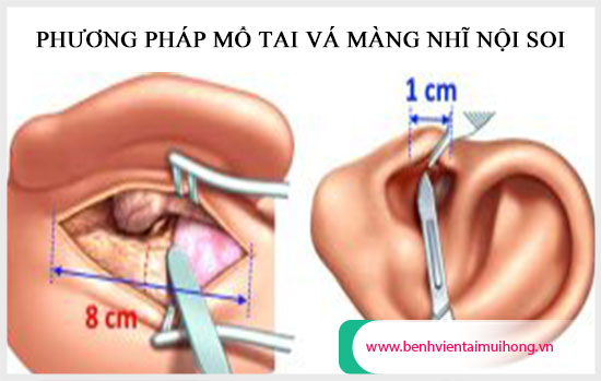 Phương pháp mổ tai vá màng nhĩ nội soi