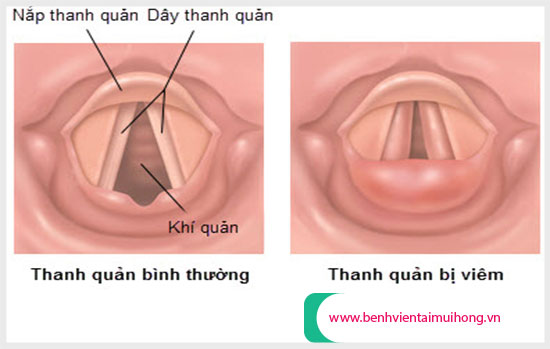 Các nhân tố gây viêm thanh quản thường gặp