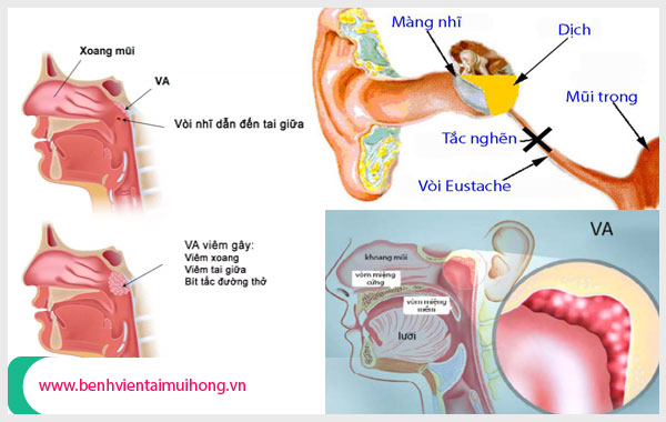 Tắc vòi tai là hậu quả của các căn bệnh ở vùng mũi, họng