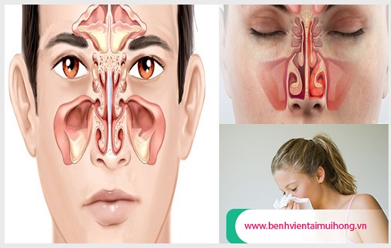 Có nhiều nguyên nhân gây bệnh viêm mũi dị ứng mãn tính