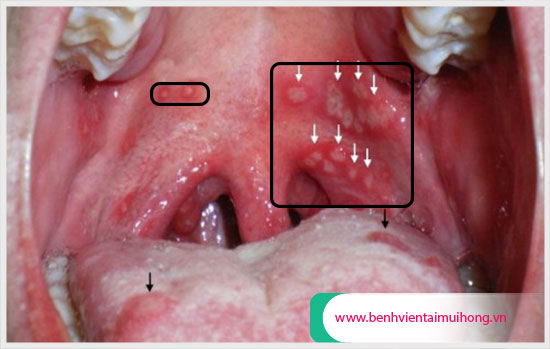 Nổi nốt hạt trắng trong miệng có biểu hiện như thế nào?