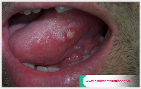 Nổi hạt trắng trong miệng có thể là bệnh lý gì?