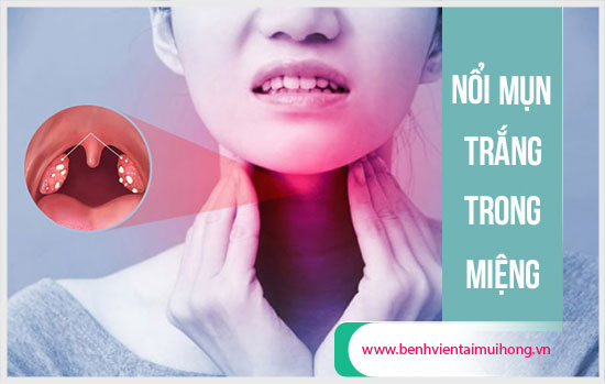 Nổi hạt trắng trong miệng có thể là bệnh gì?