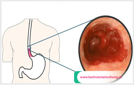 Nuốt nước bọt đau họng là bị gì? Khi nào cần đi thăm khám?