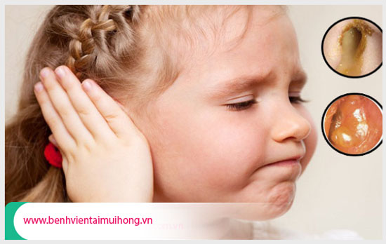 Phát hiện và điều trị kịp thời bệnh viêm tai giữa ở trẻ em