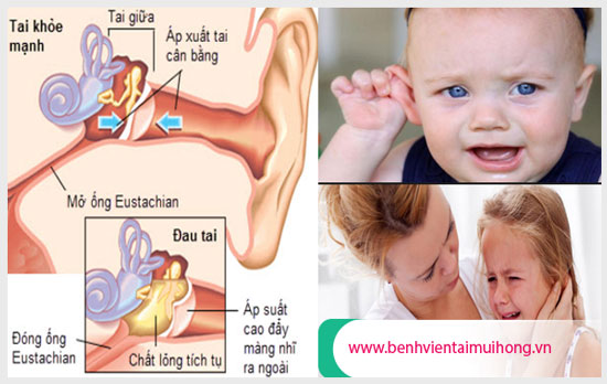 Triệu chứng nhận biết bệnh viêm tai giữa cấp ở trẻ em