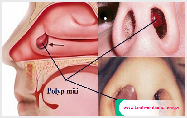 Chủ động bảo vệ mũi sẽ là phương pháp phòng trị polyp mũi ác tính