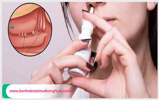 Mũi xuất hiệu nhiều mủ là triệu chứng của bệnh polyp mũi