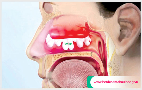 Polyp mũi 1 bên có liên quan đến đường hô hấp của chúng ta