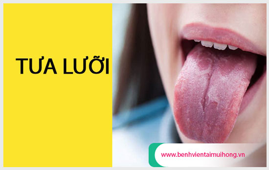 Rát lưỡi cơ thể là dấu hiệu của bệnh nấm lưỡi