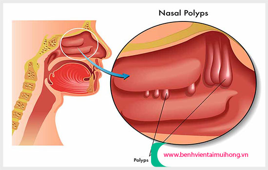 Các triệu chứng của polyp xoang hàm