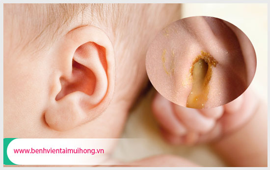 Biến chứng nguy hiểm khôn lường của bệnh viêm tai giữa