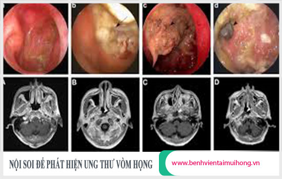 Hình ảnh nội soi chẩn đoán ung thư vòm họng