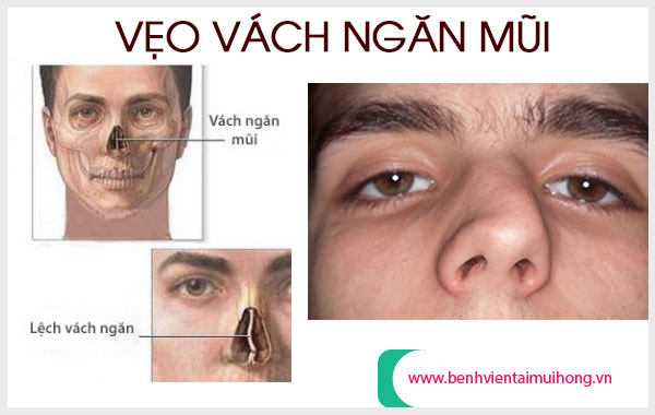 Vẹo vách ngăn mũi có thể gây biến dạng khuôn mặt
