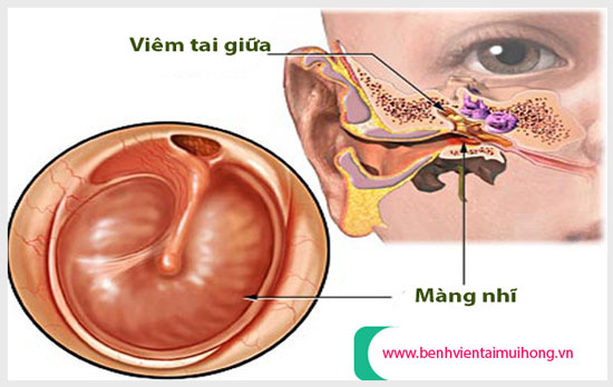Giới thiệu sơ lược về bệnh viêm tai giữa