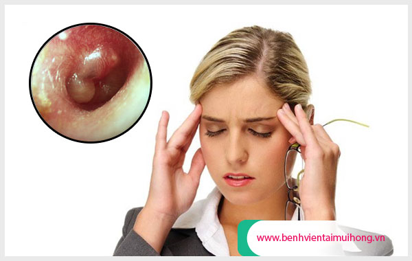 Viêm tai giữa có gây đau đầu? Và cách chữa dứt cơn đau đầu nhanh chóng