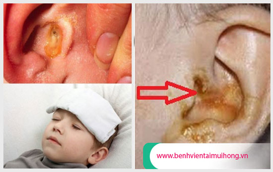 Triệu chứng nhận biết viêm tai giữa có mủ ở trẻ em
