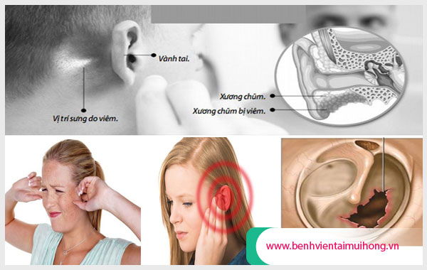 Viêm tai giữa lâu năm có thể dẫn đến điếc tai, thủng màng nhĩ